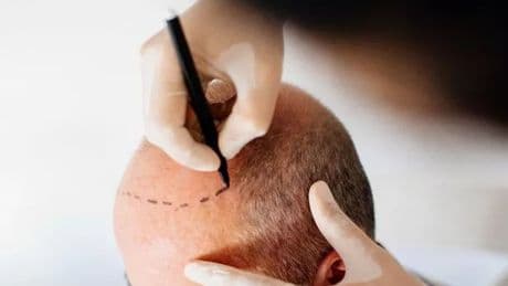 Brit dies in Turkey after undergoing hair transplant as 'homicide' probe launched