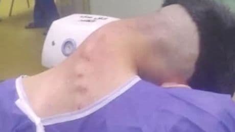 Man suffers 'dropped head syndrome' after battling one addiction for years