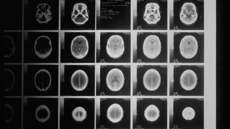 I tumori? Riconoscibili dal loro odore