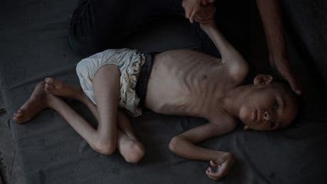 6 yaşındaki Malik 7 kiloya düştü: Gazze'de 88'i çocuk 147 kişi açlıktan can verdi