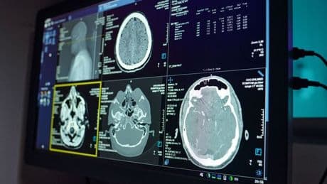 Alzheimer's study makes surprise finding over people who are more sociable