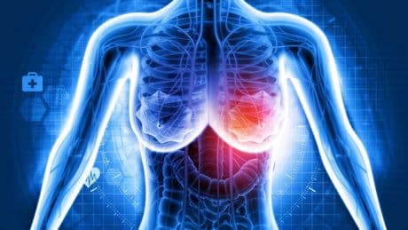 Brustkrebs: Wie KI die Diagnostik unterstützen kann