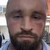 MAFS star sparks concern as he shares photos of his swollen head in post hair transplant surgery pics
