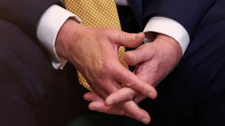Trump’s hand makeup is back during Scotland trip as he deals with chronic venous insufficiency