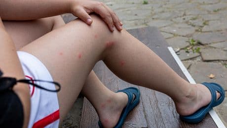 45 °C auf die nackte Haut: Diese Stichheiler helfen schnell