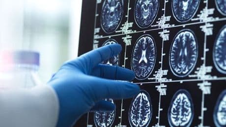 Expert reveals 5 signs of early dementia in your 50s - nothing to do with memory