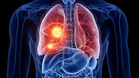 Et si les nouveaux traitements permettaient d’éviter la chirurgie contre les tumeurs pulmonaires ?