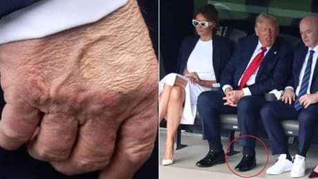 Donald Trump ha un'insufficienza venosa cronica. Il medico: «Ecco il motivo delle caviglie gonfie. I lividi? Colpa delle frequenti strette di mano»