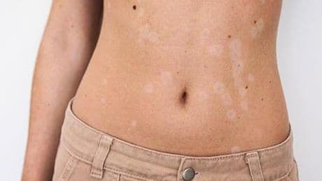 Yazın sessiz misafiri: Tinea versikolor! Güneş lekesiyle karıştırmayın