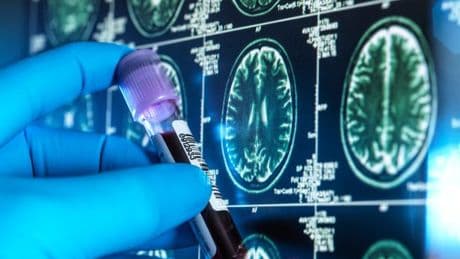 Cold sore virus leaves people at far higher risk of Alzheimer’s, study suggests