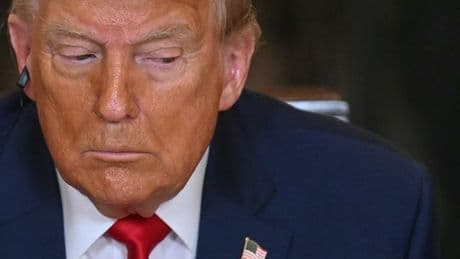 Chronic venous insufficiency: Symptoms and treatment of condition hitting Donald Trump