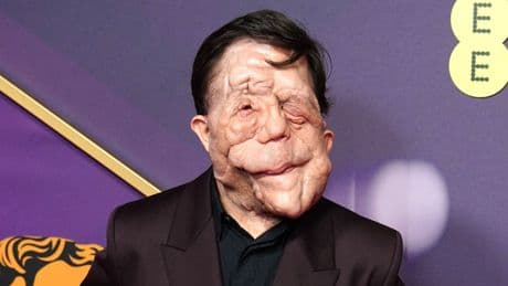 Adam Pearson to play Elephant Man in movie remake