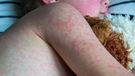 Measles cases soar in Scotland as health chiefs issue vaccination plea