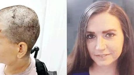 Neuralink ile 20 yıl sonra ilk! Felçli kadın yalnızca düşünerek adını yazdı