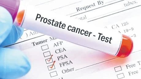 Prostat kanseri teşhisinde önemli gelişme
