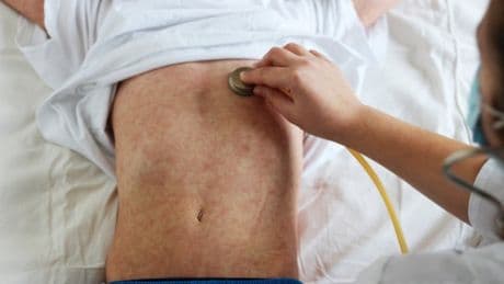 Measles warning issued to UK holidaymakers after cases rise over 120,000 in Europe