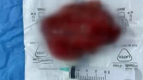 Kalbinin üzerinden tam 2 kiloluk kitle çıkarıldı!