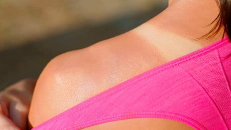 «Votre peau, c’est votre vie, vous n’en avez qu’une» : le ministre de la Santé s’allie aux dermatologues pour alerter sur la tendance TikTok des burn lines