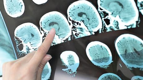 Her unutkanlık Alzheimer'a mı işaret?