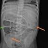 Horrifying images of giant WORMS being removed from young patient's body trigger urgent warning about drinking contaminated water