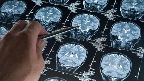Alzheimer'da yeni umut: Erken evrede teşhisi mümkün kılacak kan testi ABD'de onaylandı