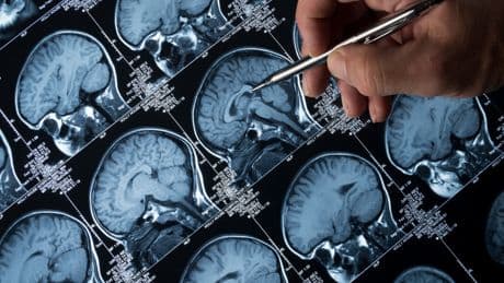 The simple blood test that can predict Alzheimer’s decline