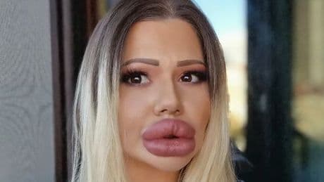 Doctor's horrifying prediction for woman with 'world's biggest lips as flesh could rot