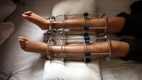 Bone-breaking height surgery shows twisted beauty standards now apply to men too