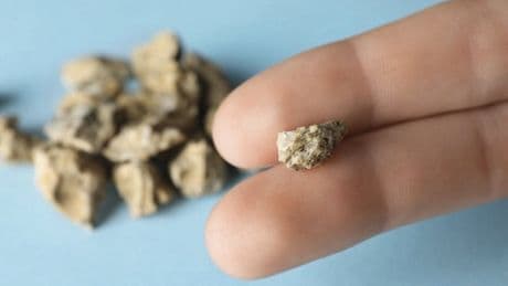 Calcul rénal : un nouveau traitement à base de bactérie espère venir à bout de cette maladie qui touche un adulte sur dix