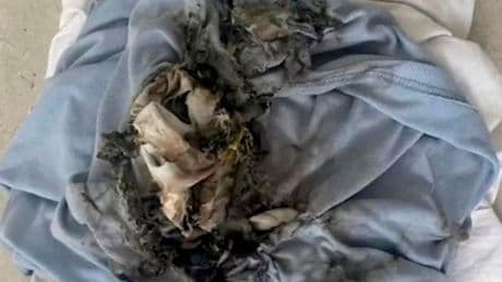 Urgent warning after woman 'set her head on fire' by vaping in hospital bed