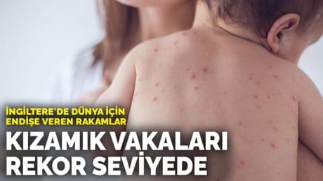 İngiltere'de dünya için endişe veren rakamlar: Kızamık vakaları rekor seviyede