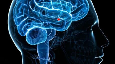 Sla, uomo paralizzato dalla malattia parla in modo fluido grazie all'IA: i microelettrodi nel cervello "traducono" i segnali cerebrali in parole