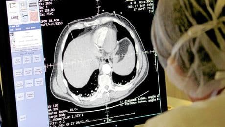En 2050, il y aura deux fois plus de cancers du foie