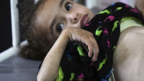 Gaza's main hospital is overwhelmed with children in pain from malnutrition