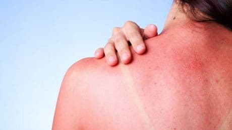 Scottature solari, rimedi e consigli su come dormire