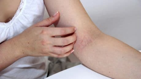 Therapien gegen Neurodermitis: Wenn die Haut chronisch juckt