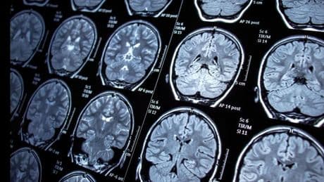 Stunden statt Wochen: Neuer Schnelltest analysiert Hirntumore im Eiltempo