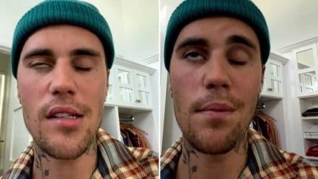 Qué es el síndrome de Ramsay Hunt, la enfermedad le paralizó media cara a Justin Bieber