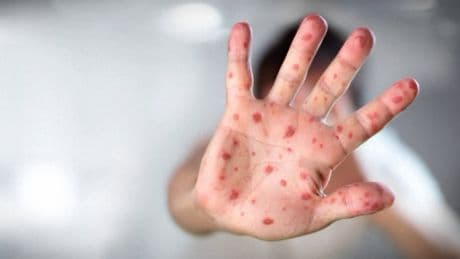 Alberta health experts warn of possible measles resurgence as kids head back to school