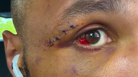 Chris Eubank Jr shows off horror bloodied eye on set of hit Netflix show after ‘almost dying’ in Conor Benn fight