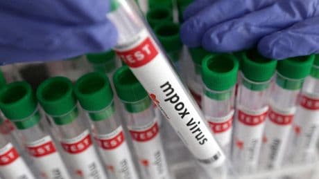 L'Organisation mondiale de la Santé maintient l'alerte face à l'épidémie de mpox