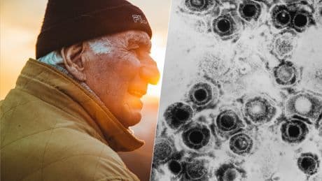 Llevamos años detectando una relación entre herpes y Alzheimer. Ahora estamos comprobando que tratar uno puede ayudar con el otro