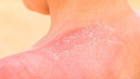 Sonnenbrand: 4 Hausmittel helfen schnell und effektiv