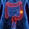 Revealed: The 20-minute routine developed by doctors that may help PREVENT bowel cancer as cases continue to surge