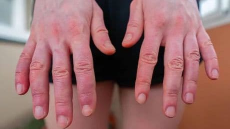 Why your hands and feet swell in the summer and how to reduce puffiness