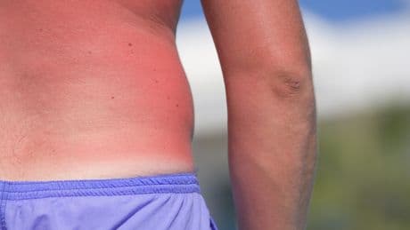 Zu oft verbrannt? Wie viele Sonnenbrände die Haut dauerhaft schädigen