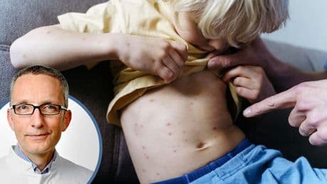 Masern, Polio, Keuchhusten - Impflücken! Drohen uns Epidemien, Herr Stiko-Chef?