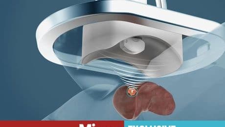 NHS to offer ‘Star Wars’ cancer treatment which pulverises tumours with sound waves