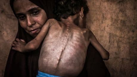 Heartbreaking images of ­Gaza kids on brink of death can no longer be ignored