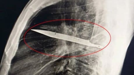 Acude al médico por una supuración y descubre que llevaba ocho años con una cuchilla en el pecho
